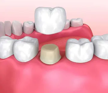 جراحی-افزایش-طول-تاج-دندان