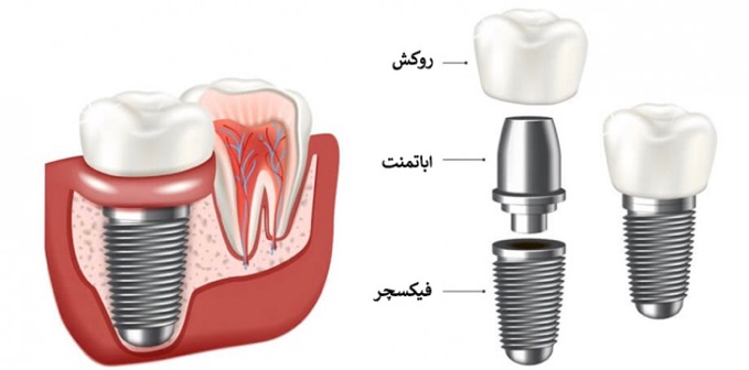 اجزای تشکیل دهنده ایمپلنت