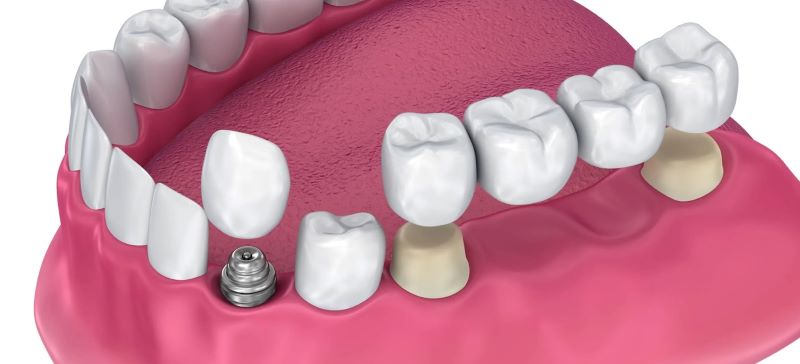 انواع روکش دندان در ونک دندانپزشکی دکتر دوستکی