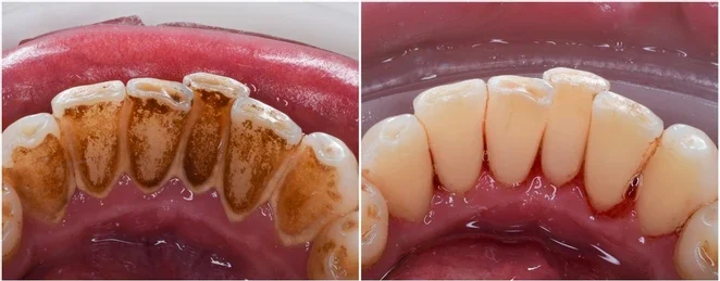 جرم گیری و سلامت دهان و دندان