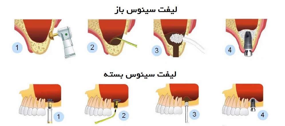 انواع جراحی سینوس باز و بسته برای کاشت ایمپلنت