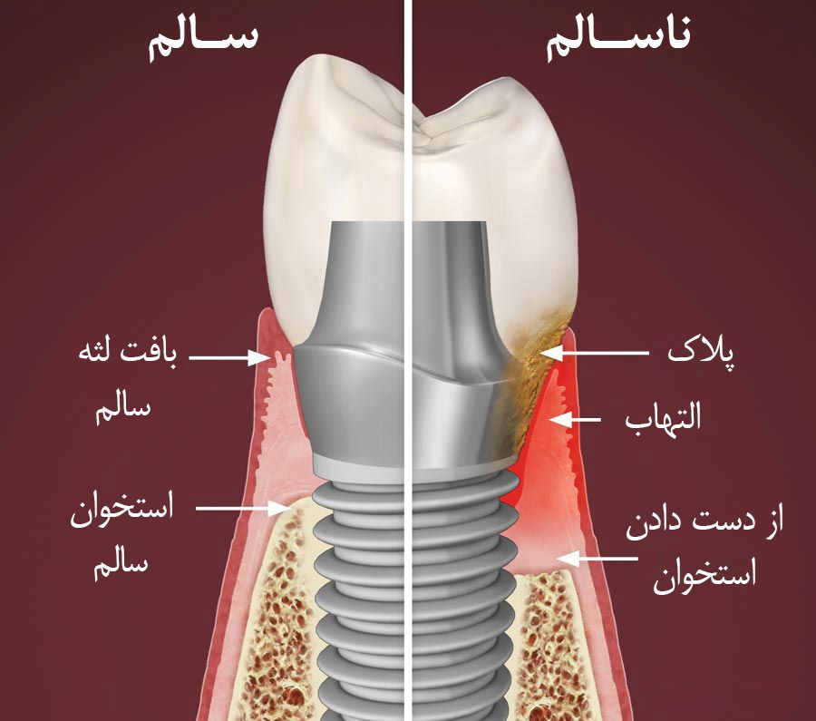 ایمپلنت دندان در ونک