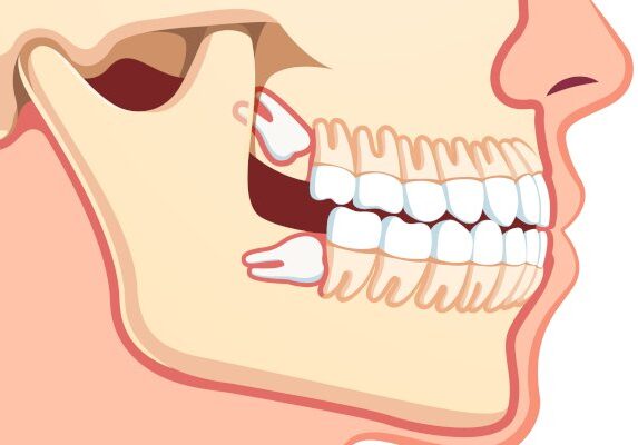 جراحی دندان عقل نهفته