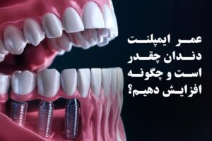 عمر ایمپلنت دندان چقدر است و چگونه افزایش دهیم؟