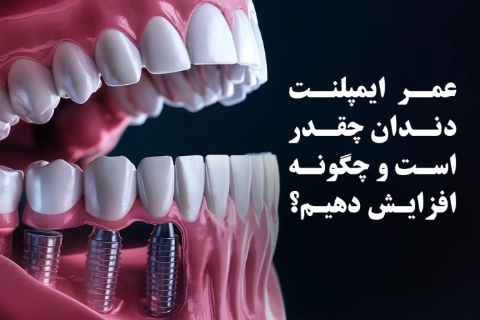 عمر ایمپلنت دندان چقدر است و چگونه افزایش دهیم؟