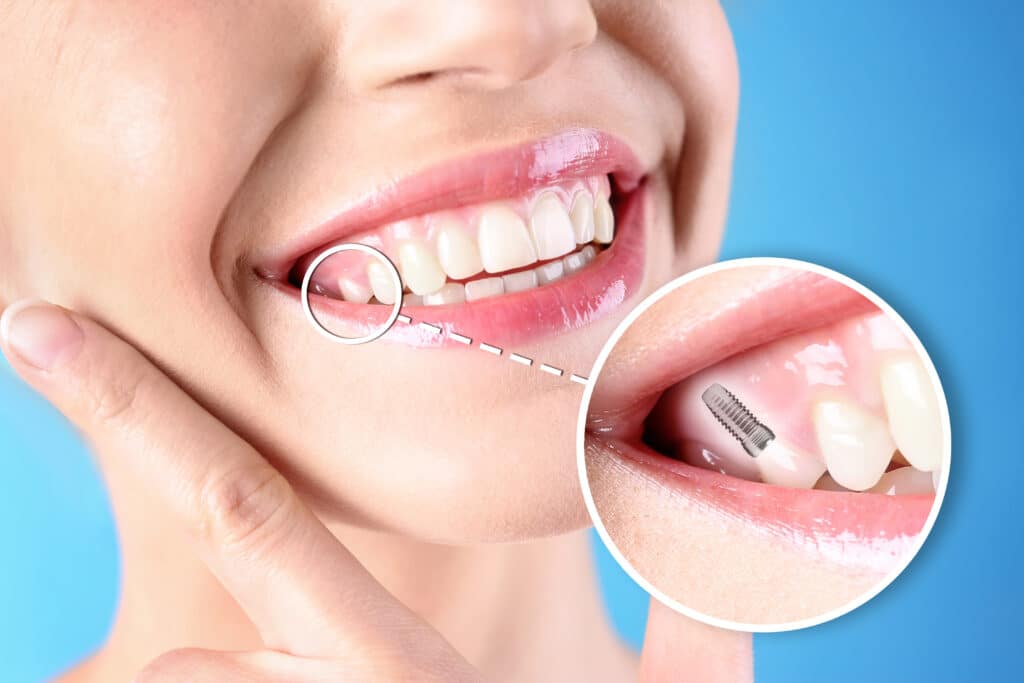 تاثیر ایمپلنت بر زیبایی لبخند