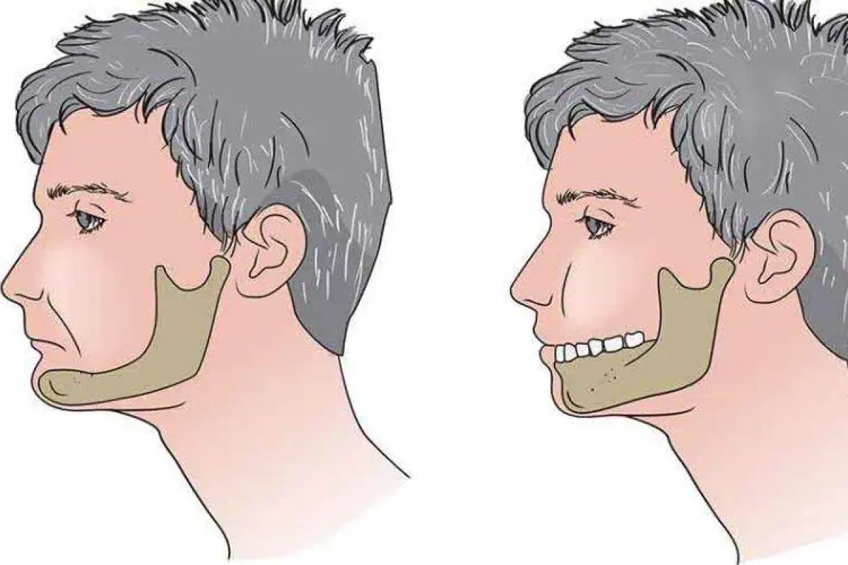 کاشت ایمپلنت دندان در ونک