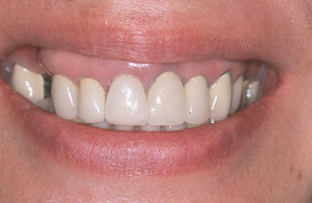 کاشت ایمپلنت دندان