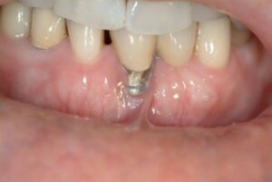 چرا بعد از ایمپلنت لثه عقب میرود؟