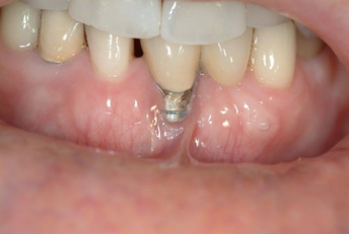 چرا بعد از ایمپلنت لثه عقب می‌رود؟