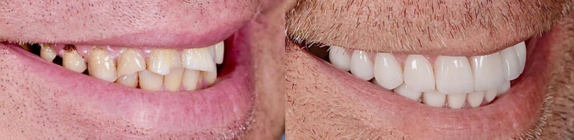 جراحی لثه قبل از روکش دندان