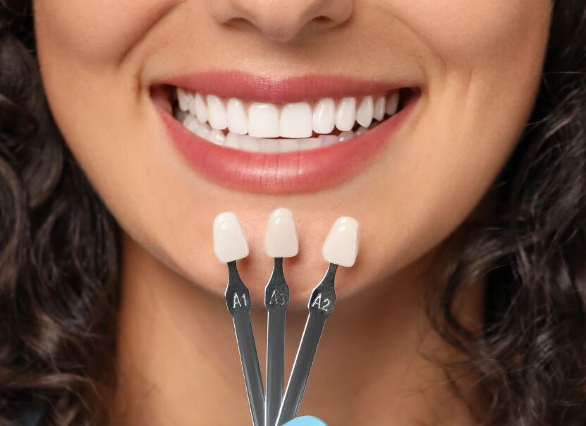 روکش دندان و زیبایی لبخند