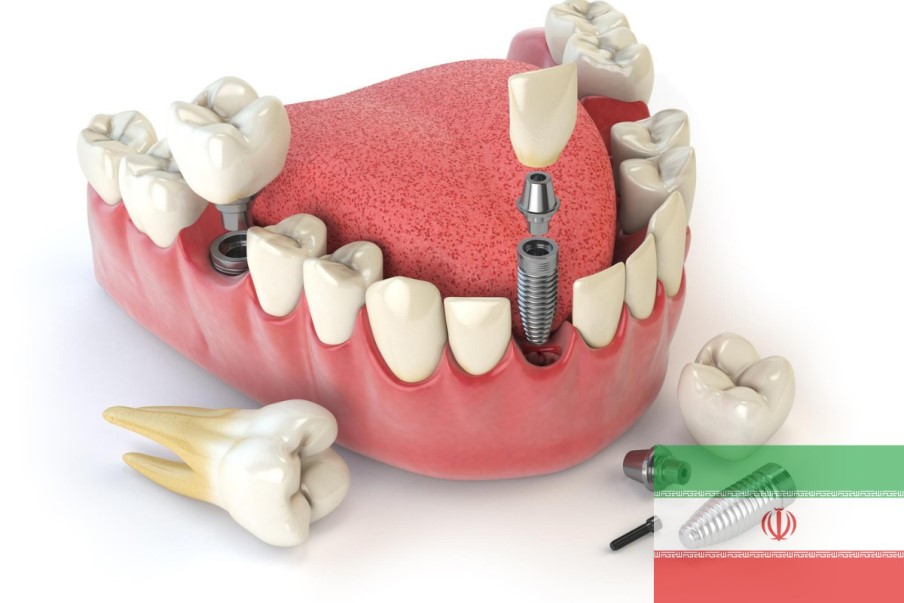 کاشت ایمپلنت