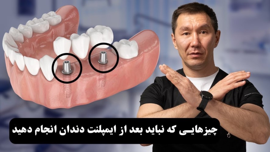 چیزهایی که نباید بعد از ایمپلنت دندان انجام دهید