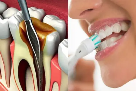 دندان عصب کشی شده