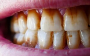 اشتباهاتی که باعث زرد شدن دندان ها میشوند