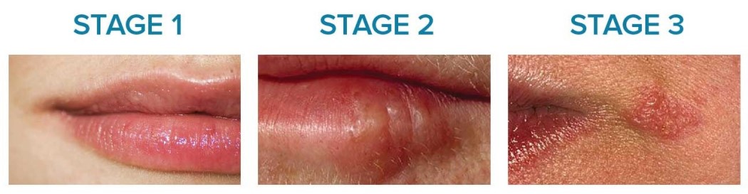 آیا با وجود تبخال می‌توان جراحی لثه انجام داد؟