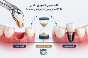 فاصله بین کشیدن دندان تا کاشت ایمپلنت چقدر است؟