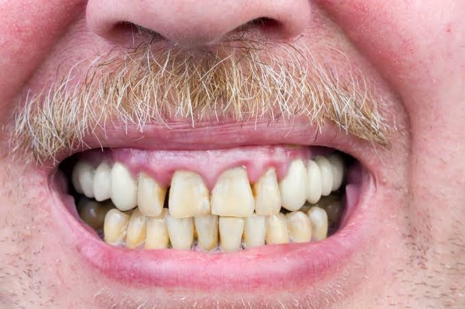 درمان تحلیل لثه تا چه حد امکان پذیر است؟